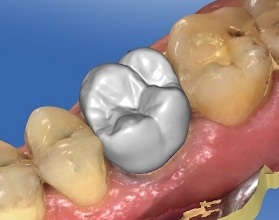 Technologie CEREC