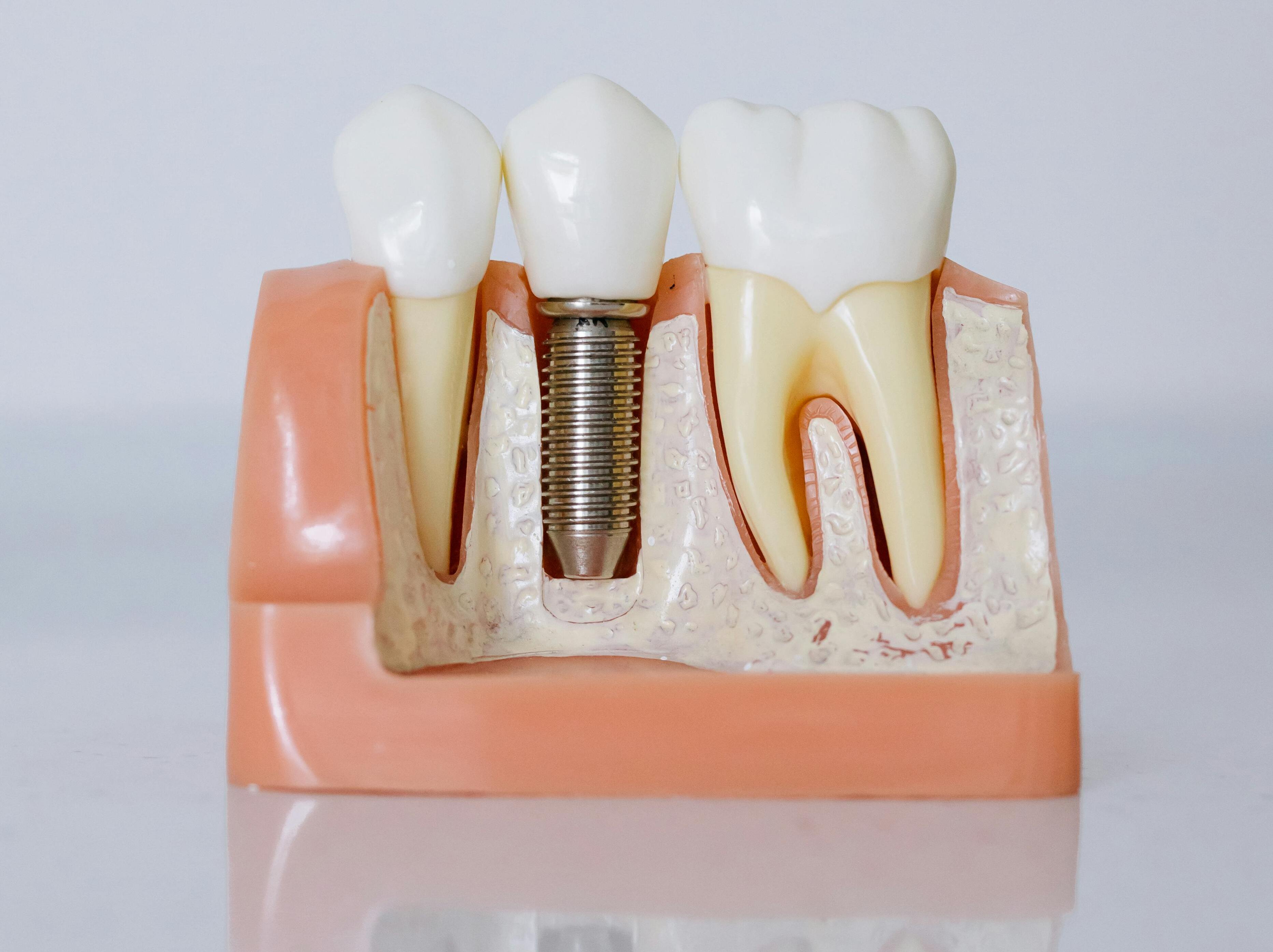 Implants dentaires
